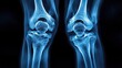 © Emile - An x-ray reveals a knee injury, highlighting healthcare and skeleton for radiology examination and internal structure assessment.