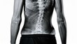 © 순단 강 - Image showing inflammation between the bones of the spine, causing pain