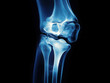 © Cheetose - X ray image of knee joint showing bones and cartilage details