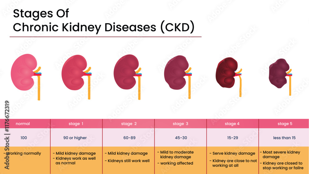 Stages Of Chronic Kidney Disease CKD Infographic Kidney Health 