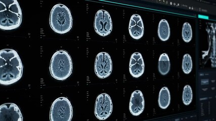 Aufkleber - Magnetic Resonance Imaging Brain Scans on Multiple Windows with Data on Computer Screen. Medical Research Environment Software User Interface with Animated MRI Results of a Patient Brain