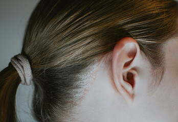 Psoriasis on a woman's head close-up with redness and peeling