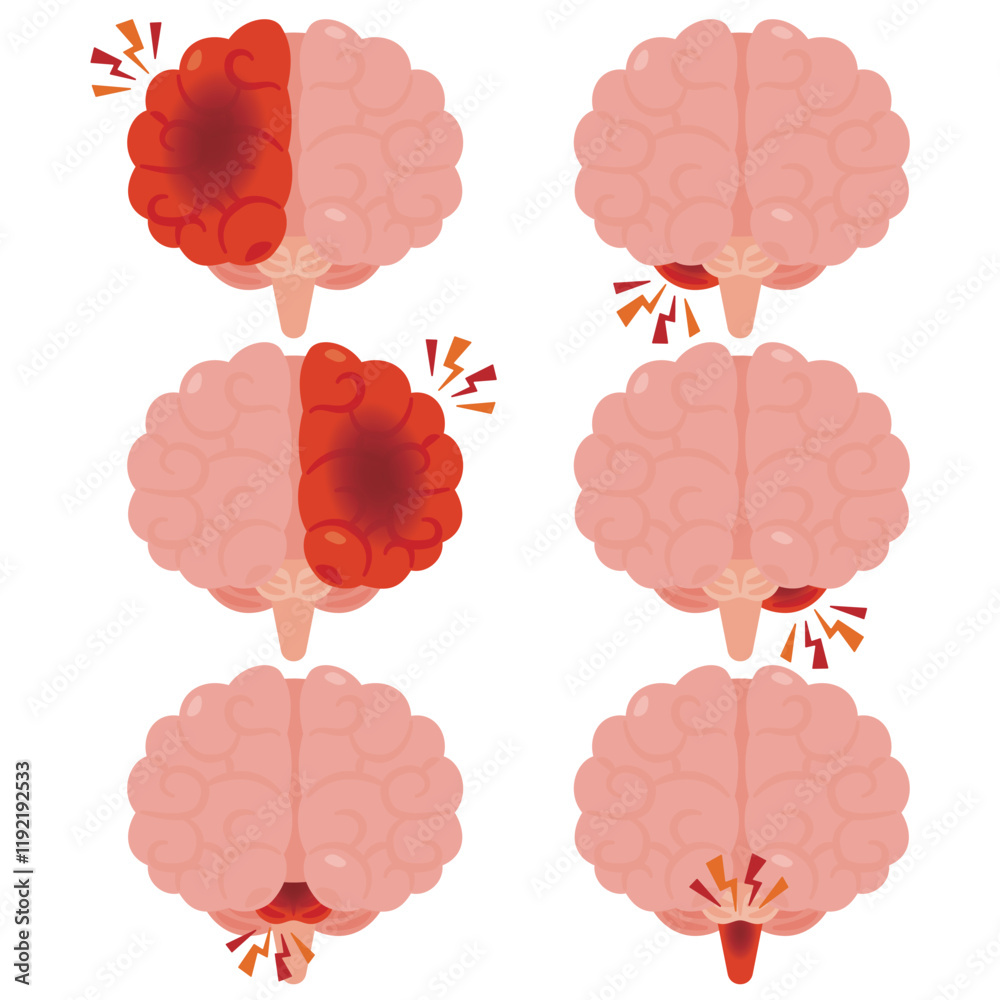 脳出血が起きた脳のイラスト 前視点 Stock Vector | Adobe Stock, image size:1000x1000