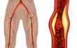 © sakurra - Atherosclerosis of the extremities. Peripheral Leg artery disease. Disease of the peripheral blood vessels that is characterized by narrowing and hardening of the arteries