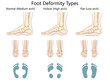 foot deformity types, normal arch, hollow high arch, and flat low arch, anatomical and footprint views diagram hand drawn schematic raster illustration. Medical science educational illustration