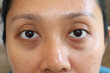 © Tanu4869 - young woman face has dark bags under her eyes. Swelling of the lower eyelid and deep. Unhealthy appearance