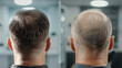 © Generative Stocks - A before-and-after transformation of a hair transplant patient. stock image, hd quality, natural look,