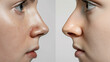 © Generative Stocks - A before-and-after comparison of a patient's nose after rhinoplasty. stock image, hd quality,