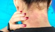© Rung Kh - portrait the rash hives allergy and inflammation skin, reaction and urticaria, scar and freckles, urticaria stigma and eczema, epidermis blister rosacea on the neck, health care and medical concept.