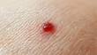 © Nhoeb - Close-Up View of Red Blood Spot on Human Skin Surface