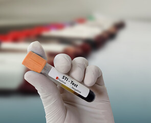 Doctor hold Blood sample for STI (Sexually Transmitted Infection) Test. Positive result test tube.