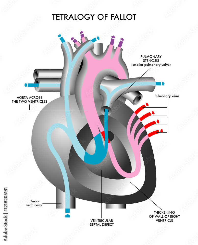 Schematic Illustration Of The Symptoms Of Tetralogy Of Fallot A schematic-illustration-of-the-symptoms-of-tetralogy-of-fallot-a