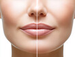 © Bohdan - Before and after lip enhancement treatment demonstrated