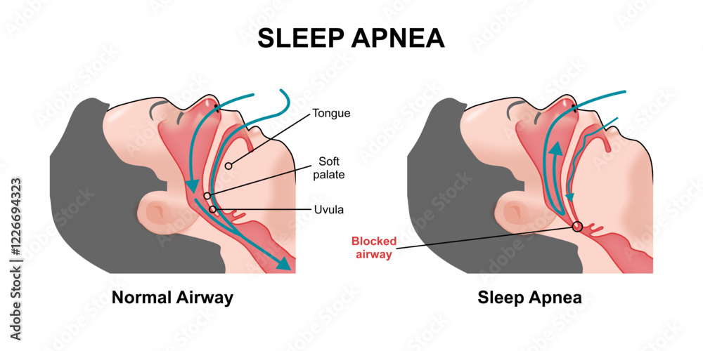 Sleep apnea airway blockage illustration Stock Vector | Adobe Stock