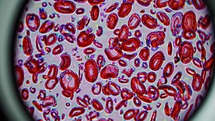 Poster - A detailed close-up of a blood smear under a microscope, highlighting abnormal cell shapes and patterns, ideal for hematology or diagnostic content.
