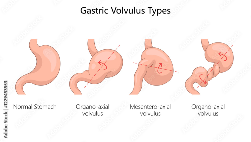 Stomach Rotation Radiology gastric volvulus types, normal stomach, organo-axial volvulus ...