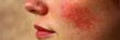 © KenPix - close-up skin texture, facial redness, inflamed cheek, dermatological condition, rosacea symptoms, skin irritation, partial view of lips, macro photography, medical detail, skin pores visible, facial