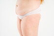 © staras - Tummy tuck, flabby skin with stretch marks on a fat belly, plastic surgery concept on gray background