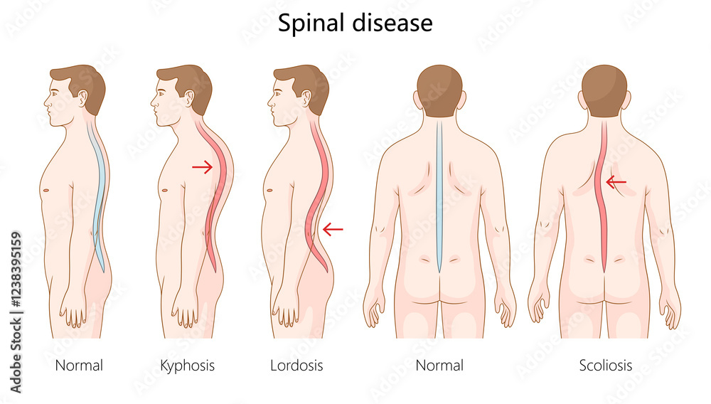 Stock Illustration normal Spine Alignment With Spinal Disorders stock-illustration-normal-spine-alignment-with-spinal-disorders