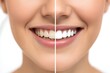 © Ева Поликарпова - A split-second comparison of a woman's natural smile before and after teeth whitening treatment