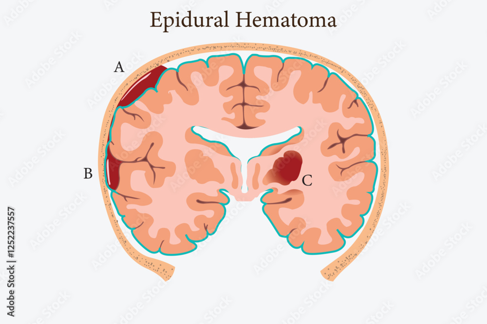 Subdural Classification Brain hemorrhage classification: epidural, subdural, and intracerebral ...