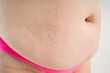 © staras - Tummy tuck, flabby skin with stretch marks on a fat belly, plastic surgery concept on gray background