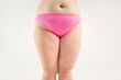 © staras - Overweight thigh, woman with fat hips and legs, obesity female body with cellulite on gray background