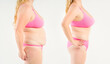 © staras - Tummy tuck, woman's fat body before and after weight loss and liposuction on gray background, plastic surgery concept