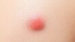 © Moopingz - Close-up of a red, inflamed bump on fair skin, a pimple or insect bite.