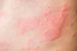© Kwangmoozaa - Skin allergy rash dermatitis texture close up background