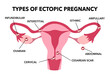 © Orapun - Ectopic Pregnancy. Types of Tubal pregnancy, ovarian, abdominal, cervical pregnancy. medical diagram with female reproductive system and various embryo attachment locations.