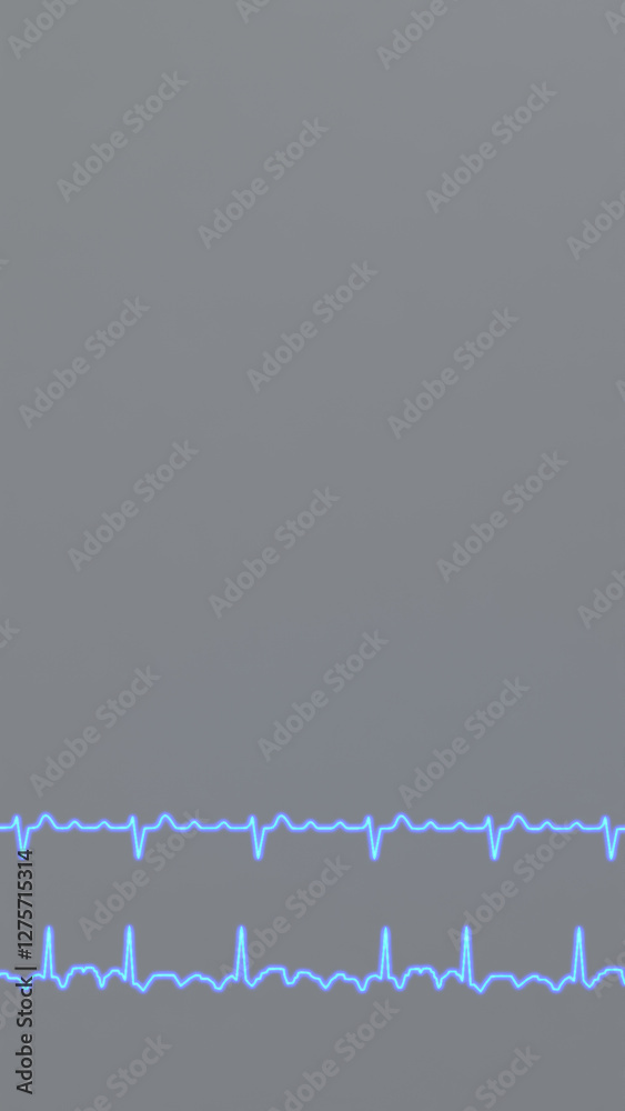 ECG graphs of regular and irregular atrial flutter Stock Illustration ...
