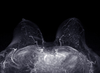 Wall Mural - MRI scan of the breasts in an axial view with contrast enhancement.