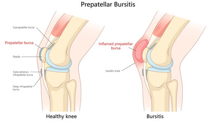 healthy knee with a knee affected by prepatellar bursitis, showing inflammation, swelling, and affected bursa anatomy diagram hand drawn vector illustration. Medical science educational illustration