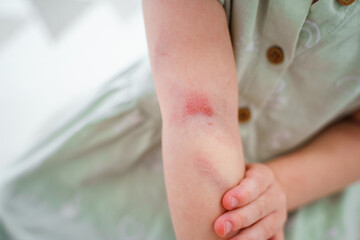 A little child girl with an abrasion, bruise and wound on her arm, a child holding a sore hand, injured kid.