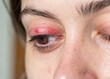 © Pujan - Close-up eye, red irritated eyelid, bloodshot sclera, swollen upper eyelid, stye infection, medical condition, detailed skin texture, macro photography, soft lighting, 8K resolution, hyper-realistic