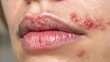 © Sweet heart - Herpes simplex with swollen, inflamed blisters, close-up