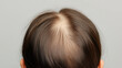 © tisomboon - Hair loss with receding hairline and thinning hair on scalp