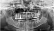 © millaf (Nemchinova) - 3D panoramic X-ray image of an adult female's teeth with dental implant x-ray image