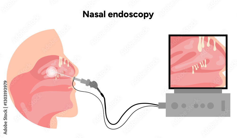 Nose Inspection Device Nasal endoscopy procedure nasal and sinus passages. Thin, flexible tube ...