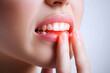 © staras - Young woman suffering from herpes on lips, health problems concept