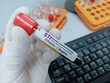 © Innovative Creation - Doctor hold Blood sample for STI (Sexually Transmitted Infection) Test. Positive result test tube.