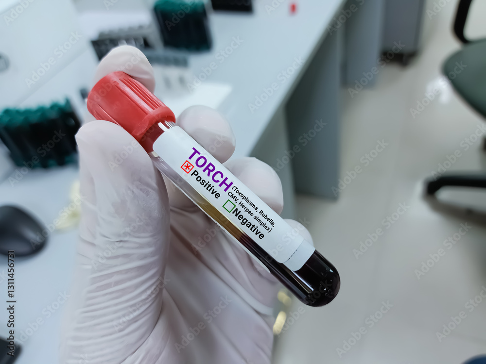 Foto Scientist hold blood sample for TORCH positive result test tube ...