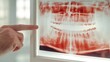 © Abdul - Close up of a dental X ray on a lightbox showing cavities and periodontal issues with a dentist pointing at the problem areas ideal for medical themes