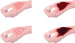 © Zulkhairi - degree of burn, Burns are classified into degrees based on the depth and severity of skin damage