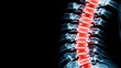 © JK_kyoto - Radiant Red Highlight on Ray of Spine in Detailed X-ray Image for Medical Awareness and Education