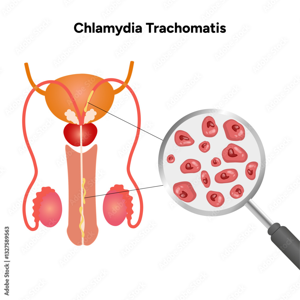 Chlamydia Trachomatis. Woman’s and man's reproductive system infections ...