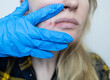 © Siniehina - Herpes on the lips of women. A dermatologist examines and treats with ointment fever blisters of the herpes simplex virus