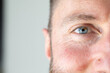 © Alessandro Grandini - Close-up of man showing signs of rosacea skin condition
