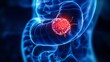© AlfaSmart - Human gastrointestinal tract with highlighted cancer tumor for medical and educational use